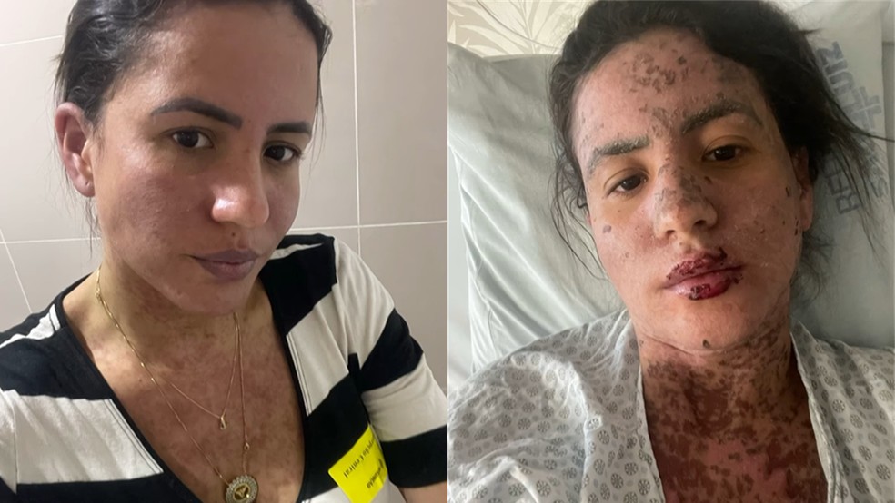 Agora recuperada, Carol Santos mostrou em um vídeo as marcas da síndrome de Stevens-Johnson pelo seu corpo.  — Foto: Reprodução/Instagram