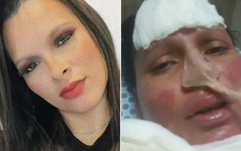 Dara Cristina de Andrade Rossato sofreu graves queimaduras após ser atacada pelo marido em Franca, SP — Foto: Arquivo pessoal