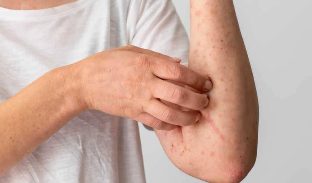 6 tipos de alergia na pele, causas e tratamento. - Alergia Botafogo -  Alergistas Rio de Janeiro