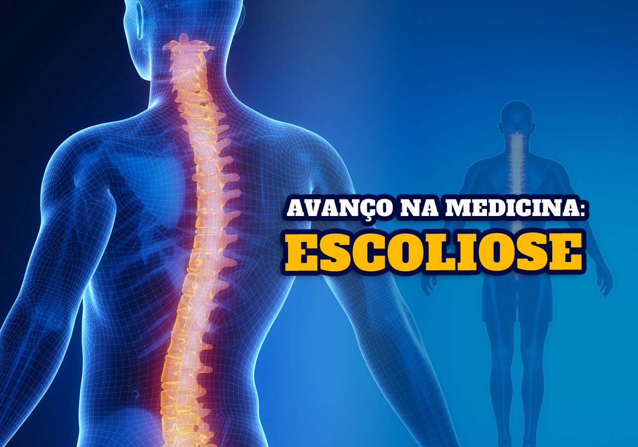 Médico brasileiro desenvolve novas técnicas para cirurgia de escoliose - Kao Isenções de IPVA, IPI, ICMS