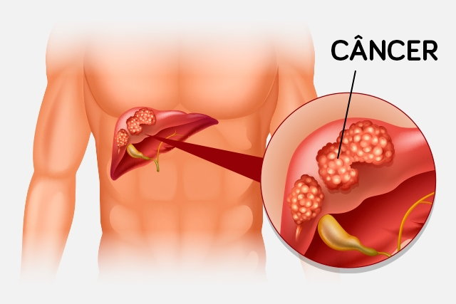 Câncer no fígado: sintomas, causas e tratamento - Tua Saúde